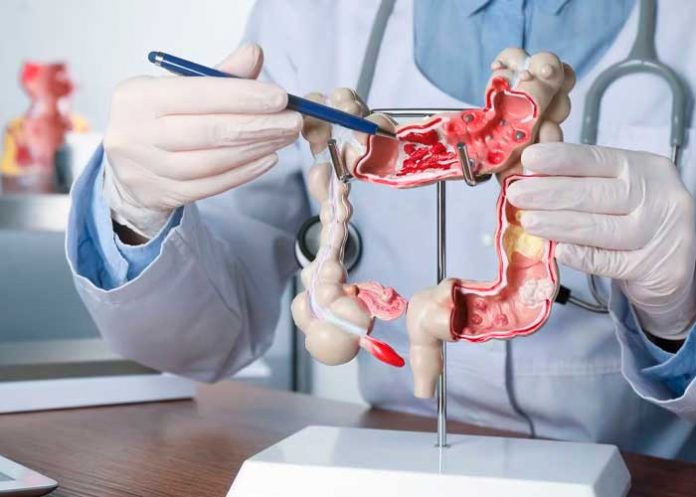 Foto: Colon sano, vida plena /cortesía