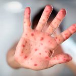 Foto: Riesgo Inminente de sarampión /cortesía