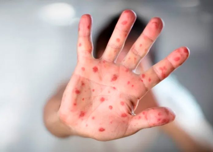 Foto: Riesgo Inminente de sarampión /cortesía