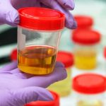 Una enfermedad muy rara: Orina con olor a jarabe ¿a qué se debe? Una enfermedad muy rara: Orina con olor a jarabe ¿a qué se debe?