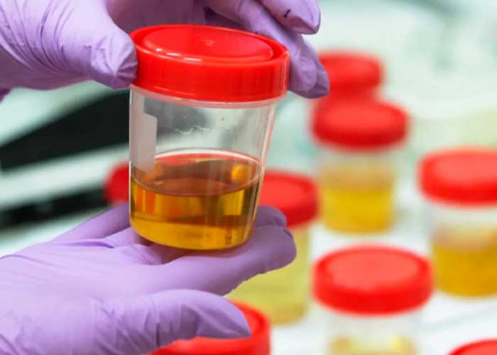 Una enfermedad muy rara: Orina con olor a jarabe ¿a qué se debe?