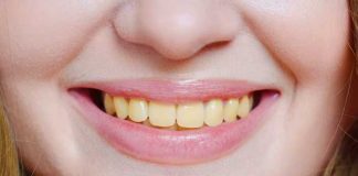 Remedio casero que “barre” el color amarillo de los dientes