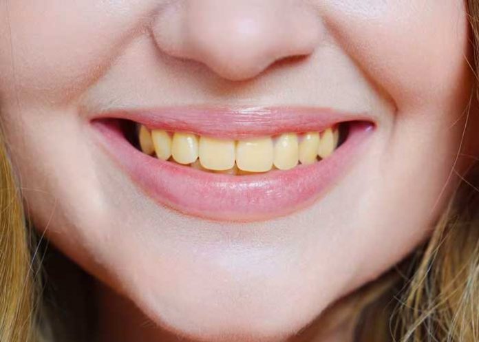 Remedio casero que “barre” el color amarillo de los dientes