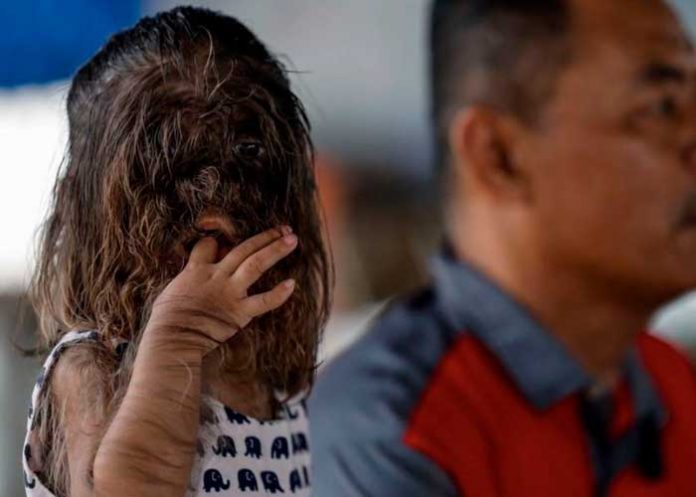 Adik Missclyen la historia de la niña con 'síndrome de hombre lobo'