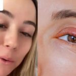 ¡Cuidado! Mujer pensó era un orzuelo y tuvo un gusano en el ojo durante 4 años ¡Cuidado! Descubre que tuvo un gusano en el ojo durante 4 años