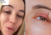 ¡Cuidado! Mujer pensó era un orzuelo y tuvo un gusano en el ojo durante 4 años ¡Cuidado! Descubre que tuvo un gusano en el ojo durante 4 años