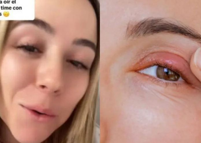 1 ¡Cuidado! Descubre que tuvo un gusano en el ojo durante 4 años