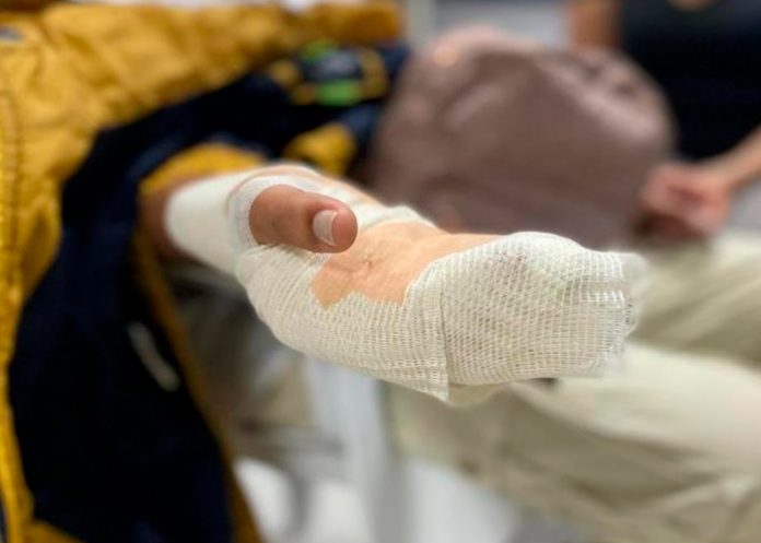 nboli1 Sufre quemaduras del 76% tras experimento escolar