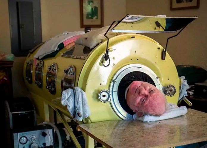 Vivió más de 70 años en un pulmón de acero