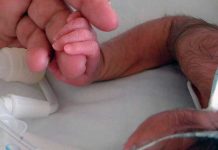 Niño nace con síndrome del hombre lobo en Filipinas