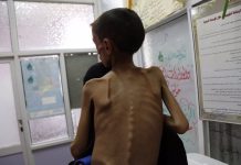 3,000 pequeños en peligro de muerte por desnutrición aguda en Gaza Foto: Niños están en peligro de morir en Gaza por desnutrición /Cortesía