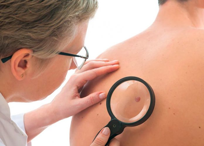 Foto: Nueva prueba indolora de detección del cáncer de piel/Cortesía Foto: Nueva prueba indolora de detección del cáncer de piel/Cortesía