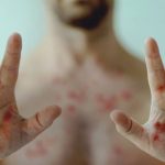 Mpox, antes viruela del mono, causa fiebre y lesiones cutáneas Foto: Mpox, antes viruela del mono, causa fiebre y lesiones cutáneas