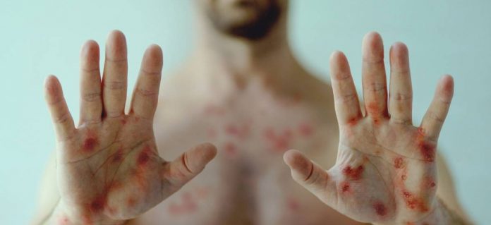 Foto: Mpox, antes viruela del mono, causa fiebre y lesiones cutáneas Foto: Mpox, antes viruela del mono, causa fiebre y lesiones cutáneas