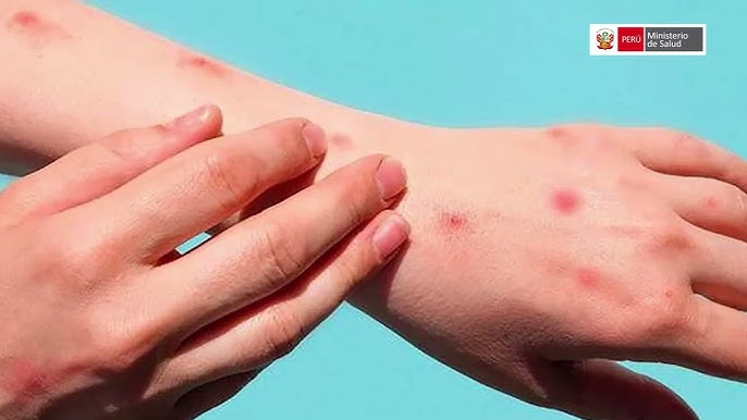 Foto: Primer caso de viruela del mono reportado en EE. UU. Foto: Primer caso de viruela del mono reportado en EE. UU.