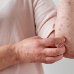 Foto: El sarampión ha regresado a Europa /Cortesía.