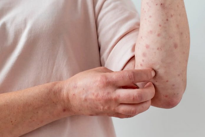 Foto: El sarampión ha regresado a Europa /Cortesía.