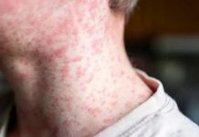 Se registran más de 800 casos de Sarampión en Estados Unidos Foto: Foto: Alerta en Estados Unidos /cortesía /cortesía