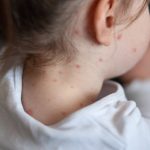 Niña de 8 años muere de sarampión y culpan a los médicos Foto: México número de casos confirmados de sarampión/cortesía