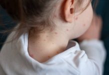 México bajo vigilancia sanitaria: Brote de sarampión supera los 400 casos Foto: México número de casos confirmados de sarampión/cortesía