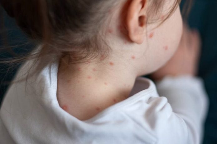 1 Foto: México número de casos confirmados de sarampión/cortesía