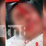 Foto: Motociclista ebrio termina con el rostro desfigurado tras accidente en Ometepe/TN8
