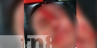 Foto: Motociclista ebrio termina con el rostro desfigurado tras accidente en Ometepe/TN8