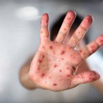 Bolivia declara emergencia sanitaria nacional por brote de sarampión Foto: Bolivia declara emergencia sanitaria nacional /Cortesía