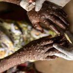 Foto: Mpox en África /cortesía