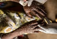 Foto: Mpox en África /cortesía