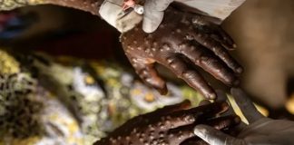 Foto: Mpox en África /cortesía