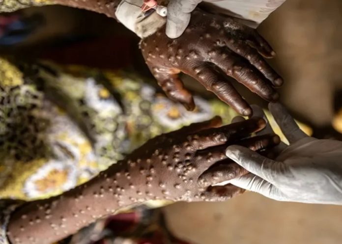 Foto: Mpox en África /cortesía