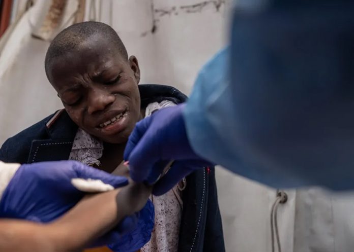 Foto: Brote de Mpox en Ghana /cortesía