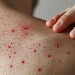 Sarampión se dispara en Bolivia con 175 casos a la fecha Foto: Emergencia sanitaria en Bolivia /cortesía