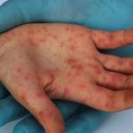 Casos de sarampión en América se disparan a más de 7.000 en 2025 Foto: Sarampión resurge en América / Cortesía