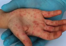 Casos de sarampión en América se disparan a más de 7.000 en 2025 Foto: Sarampión resurge en América / Cortesía