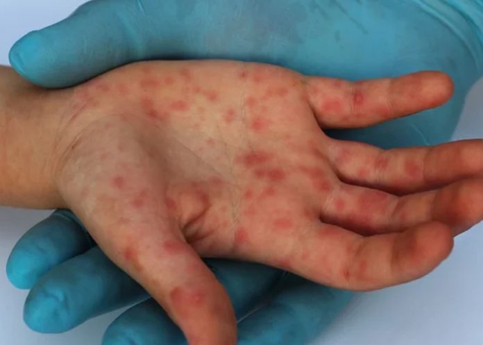 Foto: Sarampión resurge en América / Cortesía