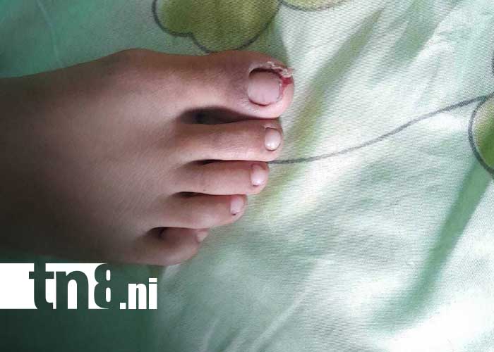 Foto: Pitbull suelto ataca a niña en San Jorge, Rivas / TN8