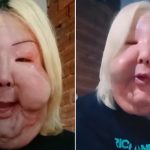 Así quedó el rostro de una influencer tras someterse a un procedimiento clandestino Foto: Deformación facial viral de influencer /cortesía