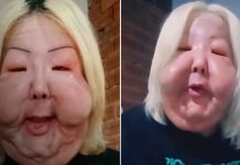Así quedó el rostro de una influencer tras someterse a un procedimiento clandestino Foto: Deformación facial viral de influencer /cortesía