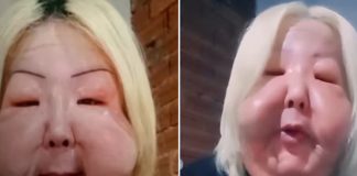 Foto: Deformación facial viral de influencer /cortesía