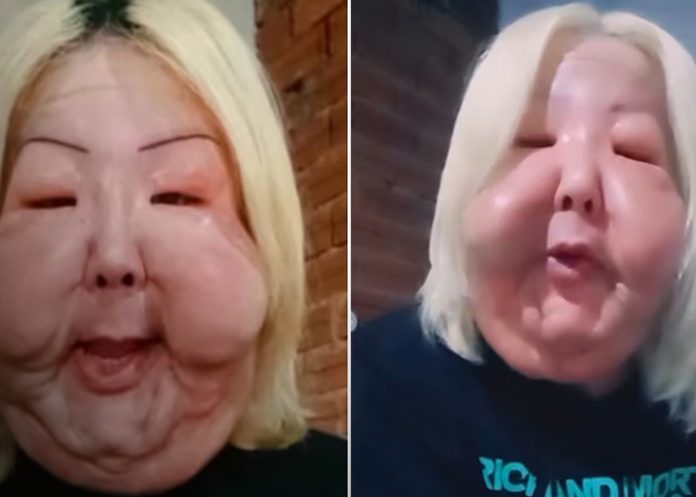 Foto: Deformación facial viral de influencer /cortesía Foto: Deformación facial viral de influencer /cortesía