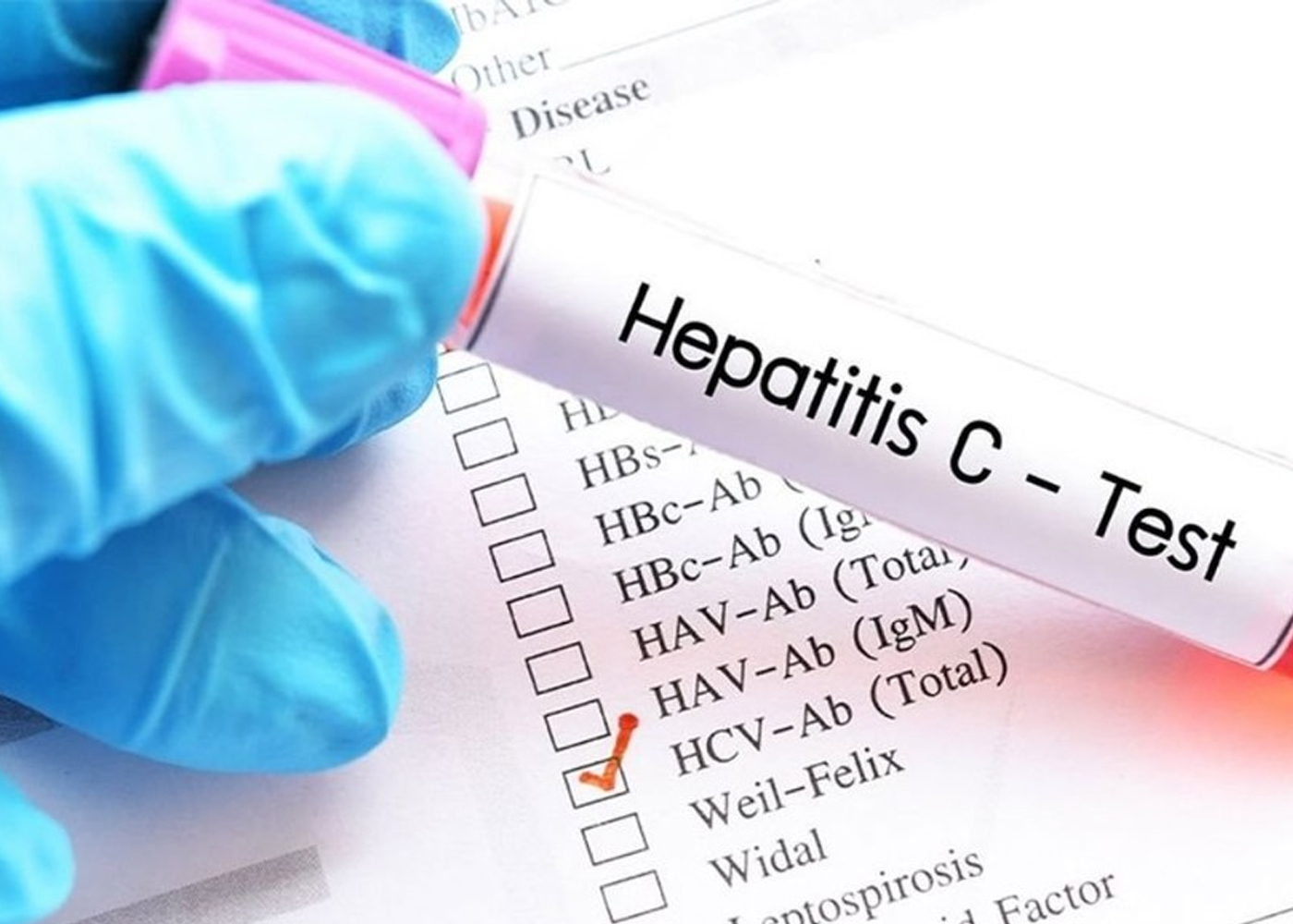Foto: Rusia presenta la primera prueba ultrarrápida para identificar casos de hepatitis C /Cortesía