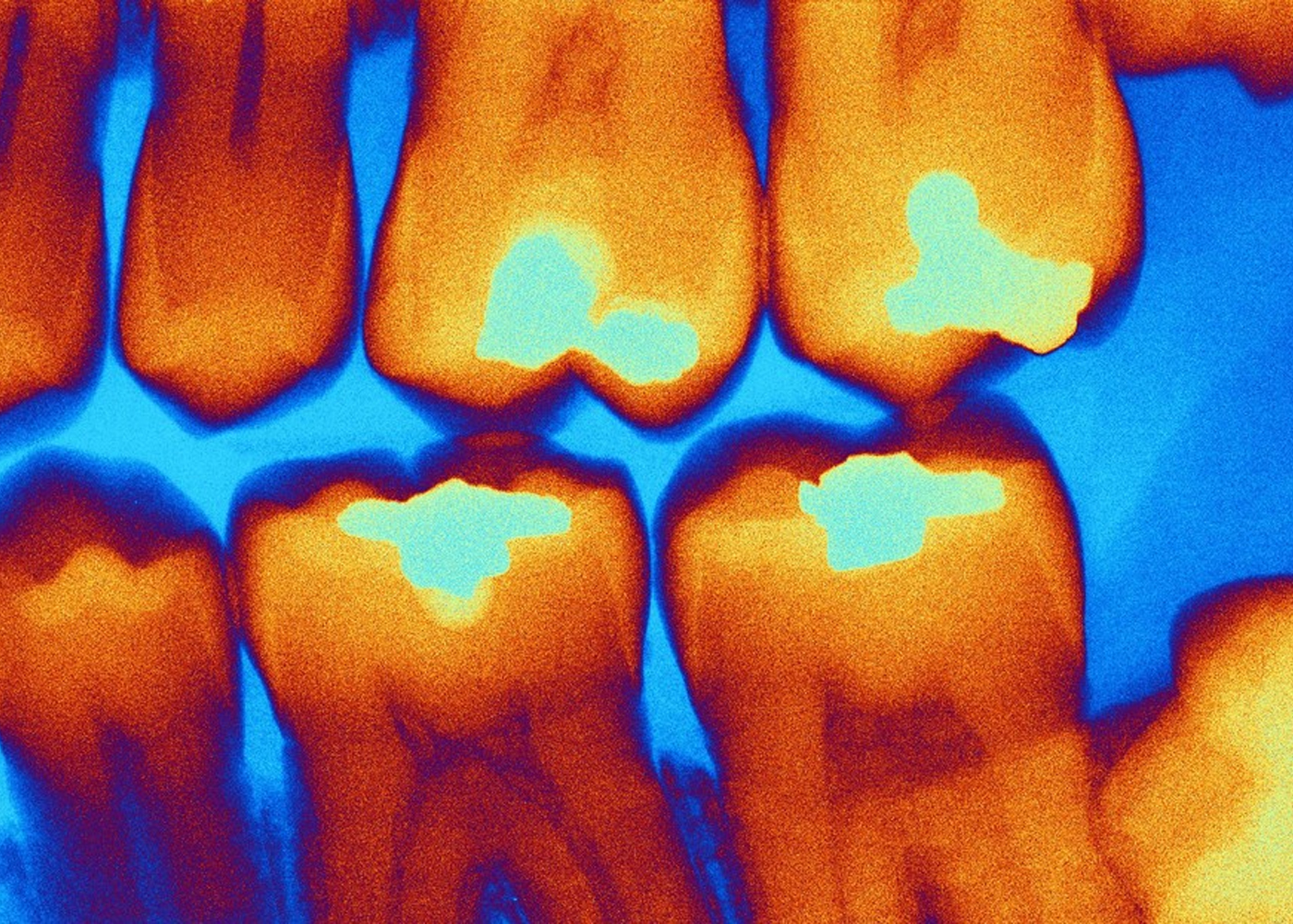 Foto: Dispositivo de Rusia identifica caries sin tintes /Cortesía