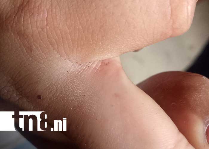 Foto: Picaduras por abejas africanizadas en Managua / TN8