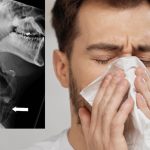 Ojo señores: Joven se fractura la garganta por contener un estornudo Foto: Se fractura la laringe por contener un estornudo /Cortesía