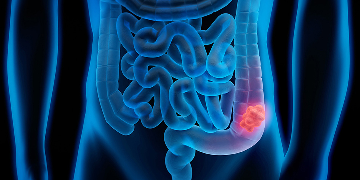 Foto: ¿La quinoa podría frenar el cáncer colorrectal? /Cortesía