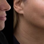 Lo que debés saber sobre la lipopapada tras el caso que llegó a juicio Foto: Lipopapada, procediminto estético