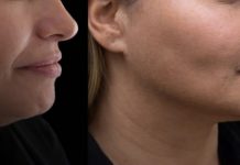 Lo que debés saber sobre la lipopapada tras el caso que llegó a juicio Foto: Lipopapada, procediminto estético