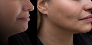 Foto: Lipopapada, procediminto estético